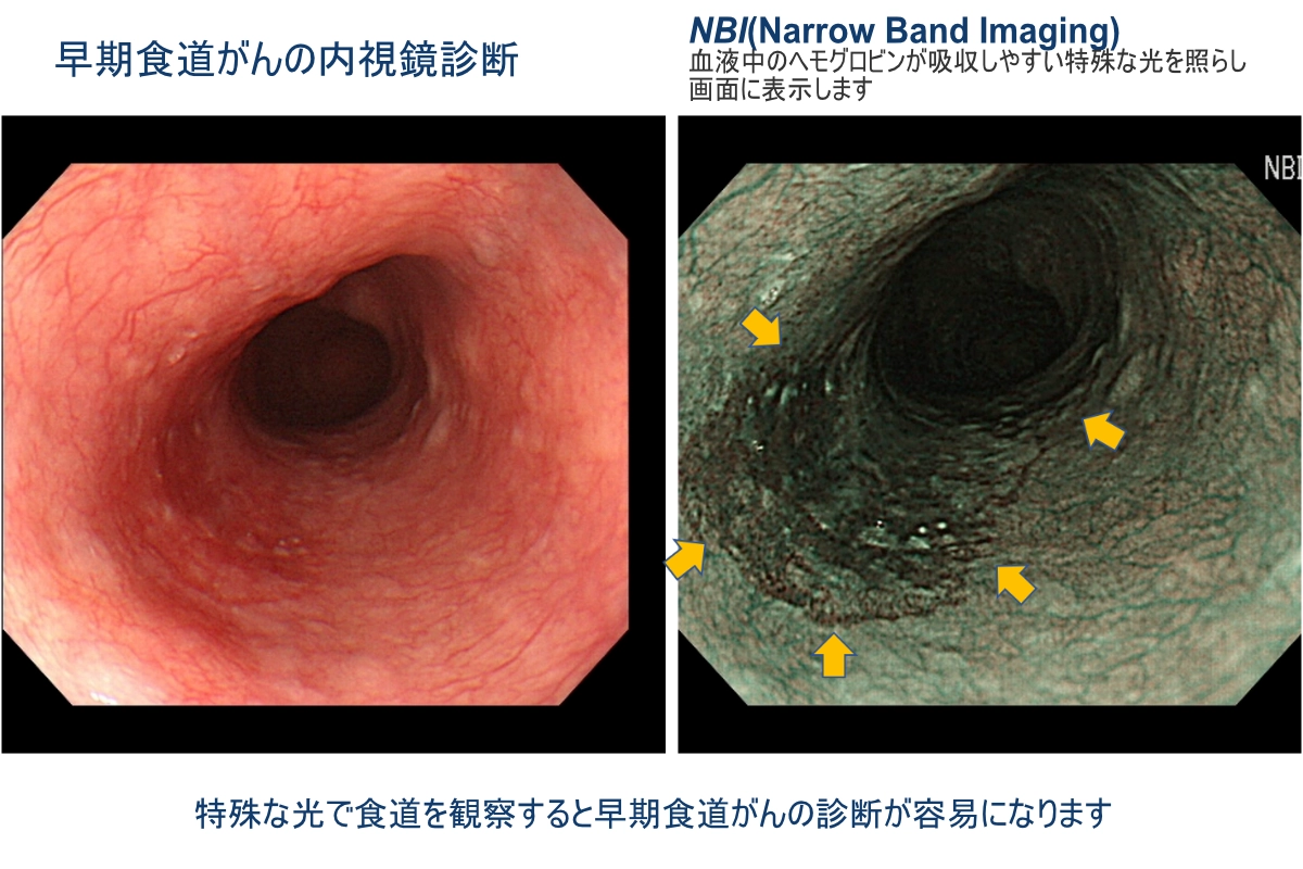 早期食道がんの内視鏡診断