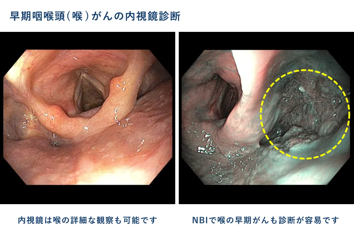 早期咽喉頭(喉)がんの内視鏡診断