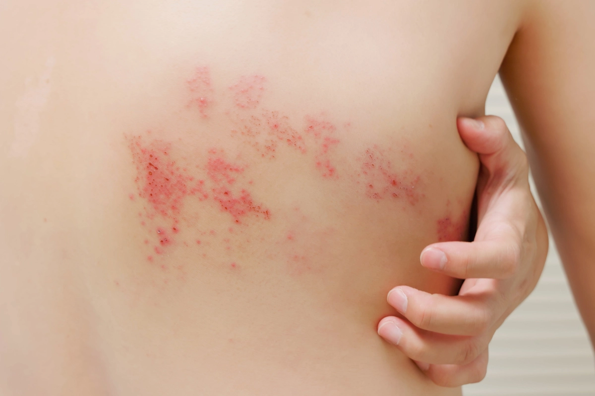 Shingles vaccine2